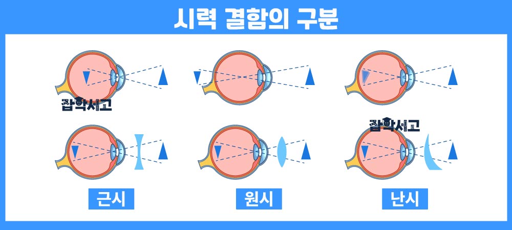 시력 저하의 구분과 특징은?