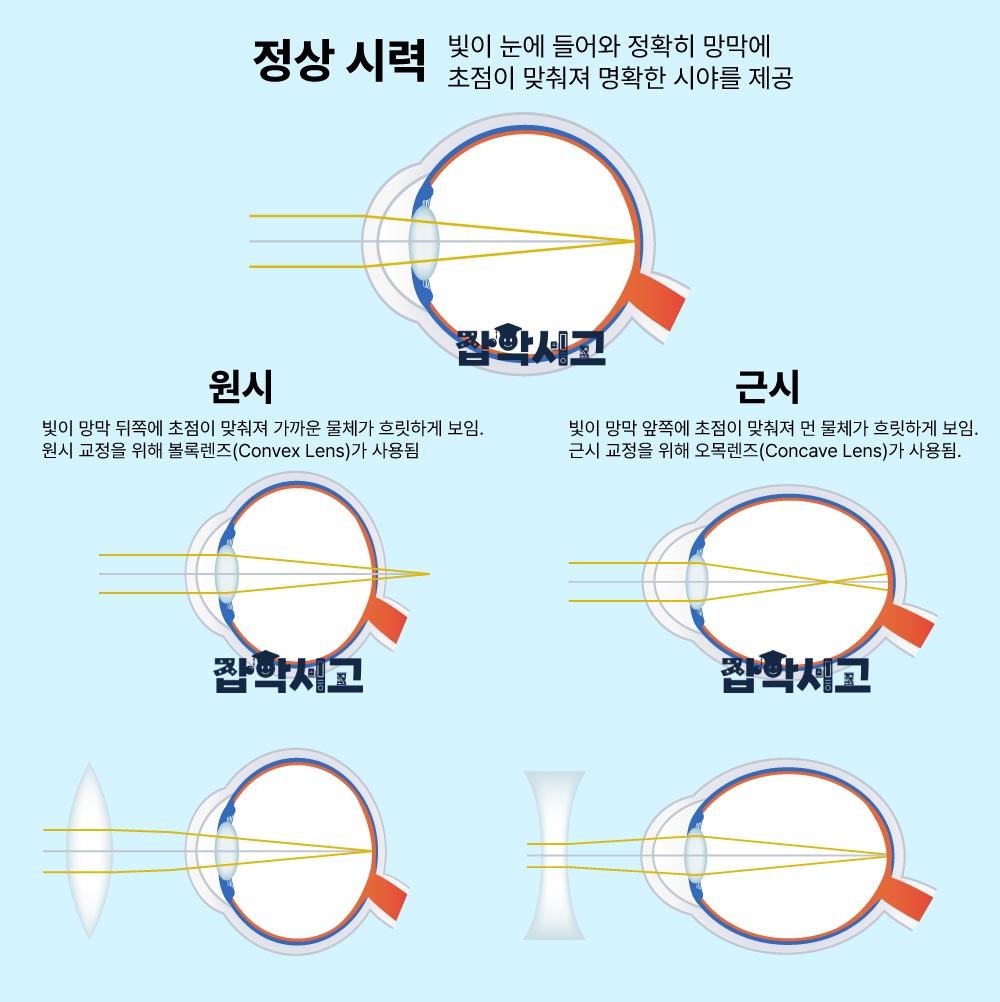 시력 저하 원인에 따른 교정 방식은?